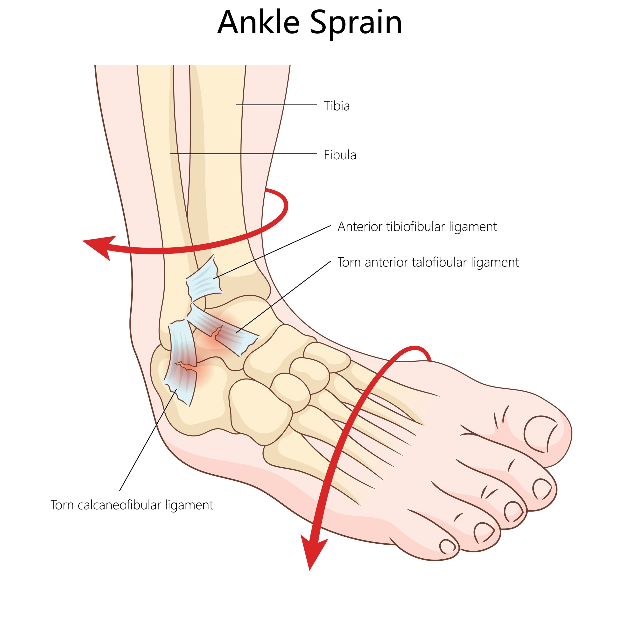 ankle instability